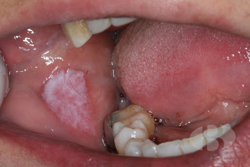 lesión oral